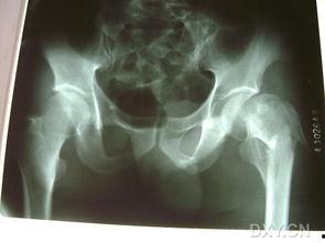 股骨颈骨折图片,影像学特征与诊断要点解析